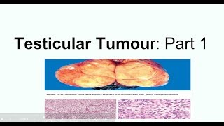 Seminoma Clinical picture Morphology and staging [upl. by Grati]