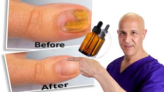 1 Oil Cures Toe Nail Fungus  Dr Mandell [upl. by Anirak]