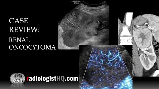 Case Review Ultrasound amp CT of Renal Oncocytoma [upl. by Squire]