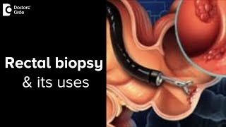 How is a rectal biopsy done Why is it necessary  Dr Rajasekhar M R [upl. by Ramyar]