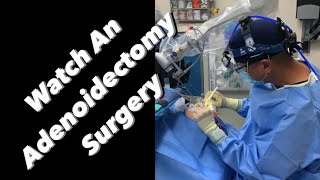 Adenoidectomy  actual footage [upl. by Livingstone]