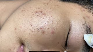 ACNE TREATMENT VU QUYNH MI Acne On Boys Chin 2024 [upl. by Selin]