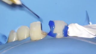 anterior Composite Restoration  Class III amp IV Composite Restoration [upl. by Gnilrad]