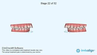 Increased overjet correction by Invisalign by Sphinx Orthodontics [upl. by Adnelg]