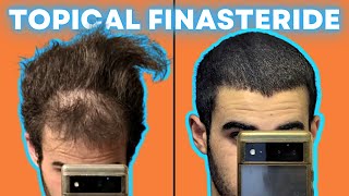 Topical Finasteride The Perfect Hair Treatment No One Talks About [upl. by Cleopatre]