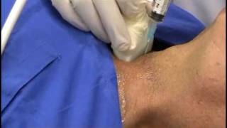 Agoaspirato Tiroideo  Fine Needle AgoBiopsy [upl. by Rodrigo]