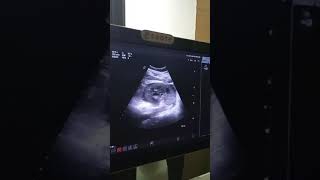 Kidney ultrasound  Ultrasound KUB  Pyonephrosis [upl. by Tallou]