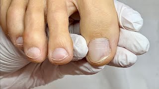 How to cut out a separated nail onycholysis [upl. by Demitria]