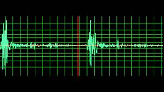 Prosthetic Mitral Valve Systolic Murmur MidDiastolic Murmur normal speed [upl. by Renmus808]