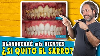 ¿Una 🧼 LIMPIEZA DENTAL 𝗕𝗟𝗔𝗡𝗤𝗨𝗘𝗔 los dientes Como 𝗤𝗨𝗜𝗧𝗔𝗥 el 𝗦𝗔𝗥𝗥𝗢💩 DE LOS DIENTES y BLANQUEARLOS [upl. by Dhaf]