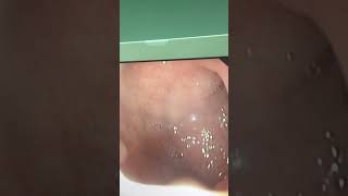 Upper endoscopy of a child with persistent vomiting one year ago showing gastritis and duodenitis [upl. by Hildick40]