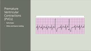 Intro to antiarrhythmics [upl. by Malsi]