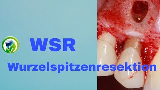 Die Wurzelspitzenresektion  WSR  retrograde Wurzelfüllung Schnittführung Zahnerhaltung [upl. by Asssilem]