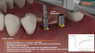 ETIII fixture with Transfer Abutment Surgical amp Prothesis [upl. by Yennaiv846]