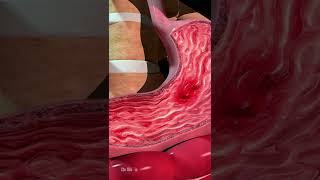 What Can Cause Stomach Ulcers Animation [upl. by Dolley]