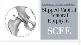 Slipped Capital Femoral Epiphysis SCFE [upl. by Ahseket]