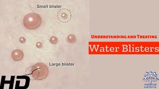 Water Blisters Unveiled Causes Treatment and Prevention [upl. by Abel581]