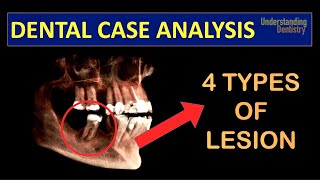 TRY TO DIAGNOSE A Case with 4 TYPES of PERIAPICAL LESIONS radicular cyst close to IAN Dental Quiz [upl. by Adrahs]