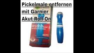 ▶︎ Akne Pickel Narben entfernen wegbekommen loswerden  Garnier Hautklar gegen Pickel [upl. by Orgalim299]