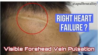 Visible forehead vein pulsation due to markedly elevated jugular vein pressure JVP in RHF [upl. by Ecirtak173]