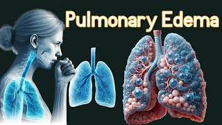 Pulmonary Edema Fluid In the Lungs Symptoms amp causes [upl. by Yrehcaz362]