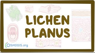 Lichen planus  causes symptoms diagnosis treatment pathology [upl. by Bever390]