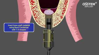 Internal Sinus Lift [upl. by Nyliac]