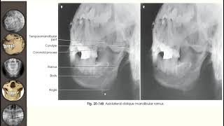 Teknik Radiografi Mandibula [upl. by Aileen948]