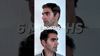 HAIR TRANSPLANT AND A SUCCESSFUL RESULT IN 9 MONTHS  SMILE HAIR CLINIC hairtransplantturkey [upl. by Eisor]