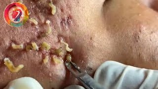 Ultimate Pimple Popping 2024 Satisfying Blackhead Extractions amp Acne Solutions [upl. by Binah]