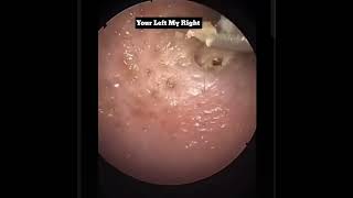 most satisfying nose blackhead removal videos [upl. by Tudor]