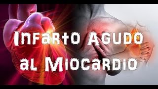 Infarto agudo al miocardio [upl. by Deevan925]