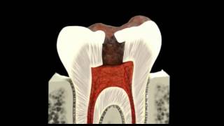 Dental abscess Animation [upl. by Dorsman]