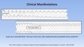 Hyperkalemia [upl. by Katherina]