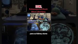 Extracorporeal Shock Wave Lithotripsy for Kidney Stone [upl. by Arammahs351]