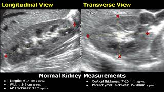 How To Measure Kidney On Ultrasound  Renal Length Width AP Thickness amp Volume Measurements USG [upl. by Atirahs]