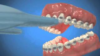 Orthosmile  AcceleDent System [upl. by Ylrehs]