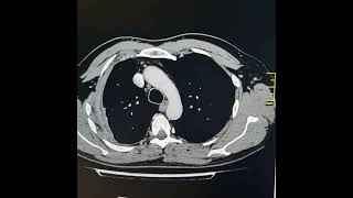 Small hydropneumothorax on right side with pleural cortication [upl. by Colline787]