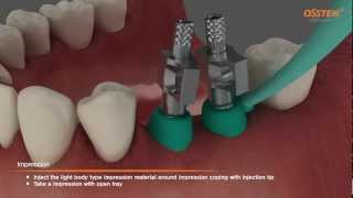 TSIII Fixture Placement amp Impression taking Pickup and Transfer Impression Copings [upl. by Nesaj304]