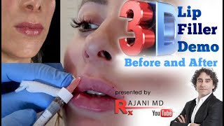 Watch 3D LIP FILLER INJECTIONS Lip Filler Before and After [upl. by Virgie]