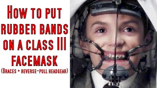 How to put rubber bands on braces protraction facemask [upl. by Blakely]