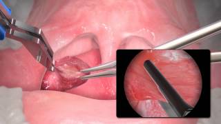 Microline® ENTcep tional Tonsillectomy Animation [upl. by Rosalinde369]