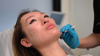 The Process of SkinVive Injectable Skin Booster Treatment by Juvederm [upl. by Brynne]