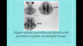 3 Parathyroid scan Ekram Ali [upl. by Ettennad36]