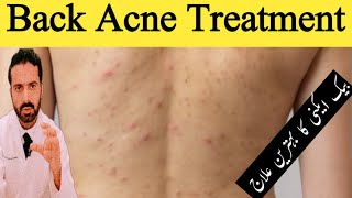 Treatment of Back Acne Shoulder Acne and Chest Acne in Urdu  Get Rid Of Back Acne  Dr Nadeem Rph [upl. by Ennail939]