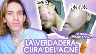 ROACCUTAN o ACCUTANE Efectos adversos como tomarla antes y despues LA VERDAD de la ISOTRETINOINA [upl. by Gillette]