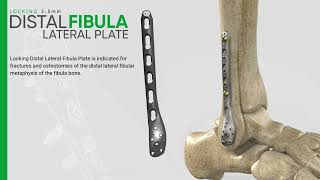 Zimed  Locking Distal Lateral Fibula Plate [upl. by Ahsilav]