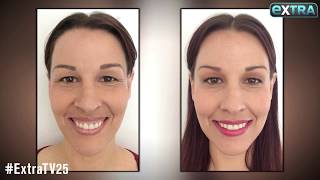 Beauty in Real Time A Quick and Painless Way to Fix a Gummy Smile [upl. by Aleik]