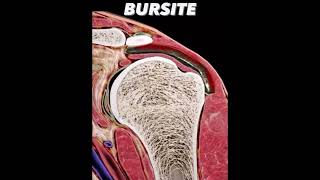 Bursite of the shoulder anatomy neet usmlestep upperlimbanatomy [upl. by Ilke]