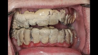 20 Years Without Brushing Teeth 😦  Calculus Removal [upl. by Eima]